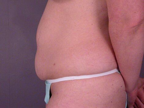 Liposuction Before & After Image