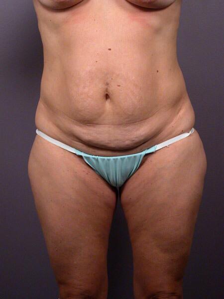 Liposuction Before & After Image