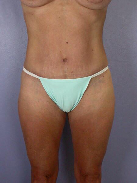 Liposuction Before & After Image