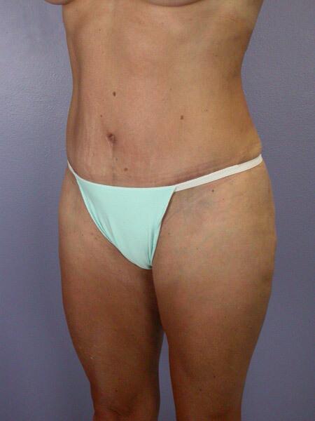 Liposuction Before & After Image