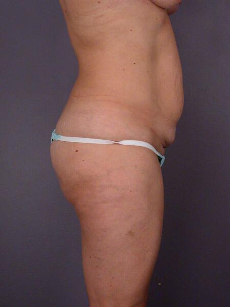 Liposuction Before & After Image