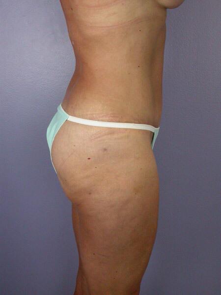 Liposuction Before & After Image