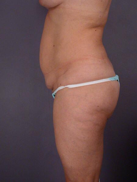 Liposuction Before & After Image