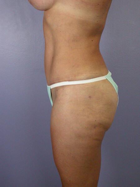 Liposuction Before & After Image