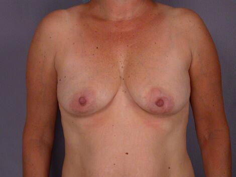 Liposuction Before & After Image