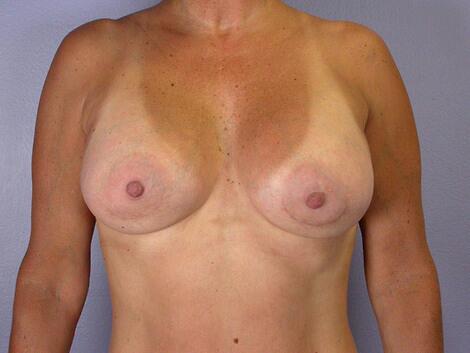 Liposuction Before & After Image