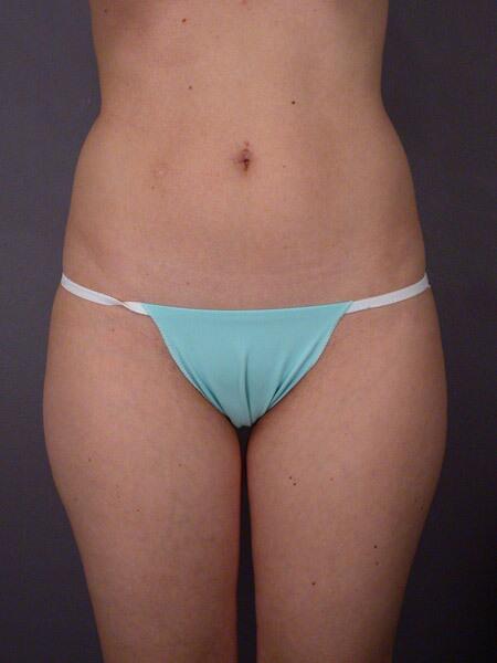 Liposuction Before & After Image