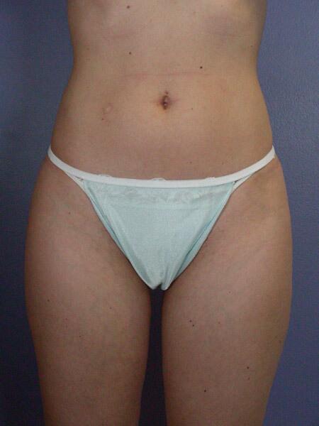 Liposuction Before & After Image