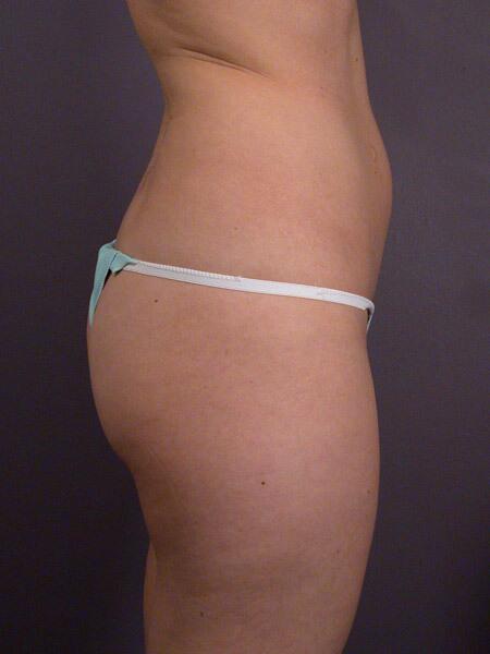 Liposuction Before & After Image