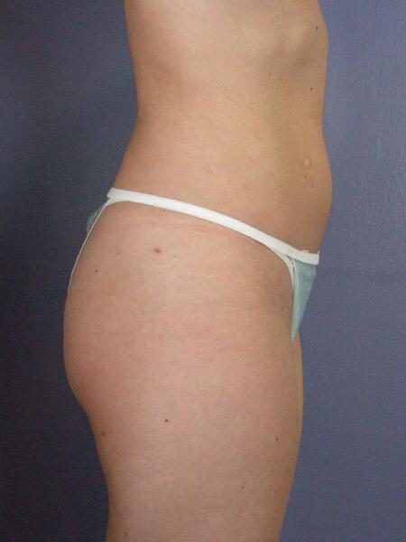 Liposuction Before & After Image