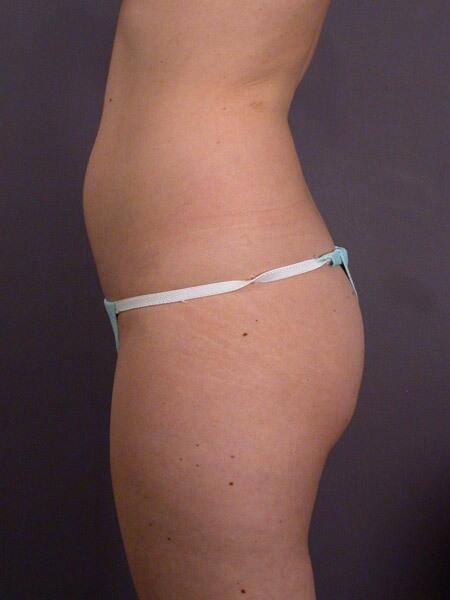 Liposuction Before & After Image