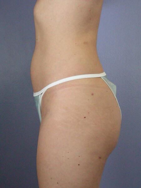 Liposuction Before & After Image