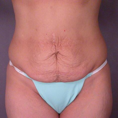 Liposuction Before & After Image