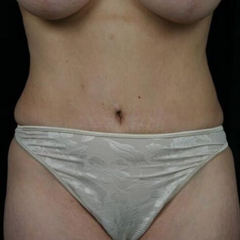 Liposuction Before & After Image