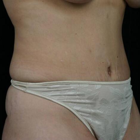 Liposuction Before & After Image