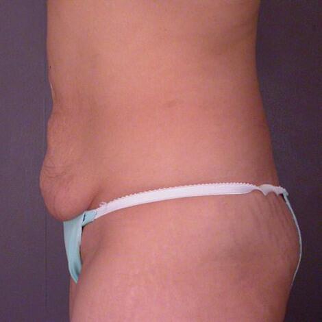 Liposuction Before & After Image