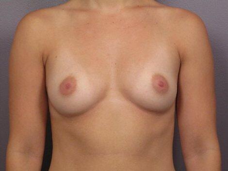 Liposuction Before & After Image