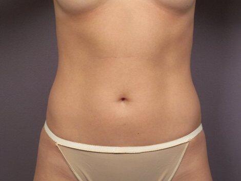 Liposuction Before & After Image