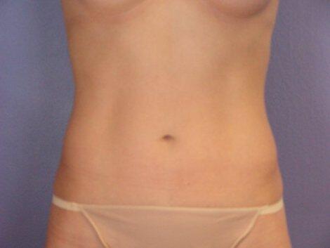 Liposuction Before & After Image