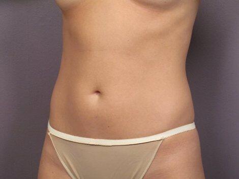 Liposuction Before & After Image