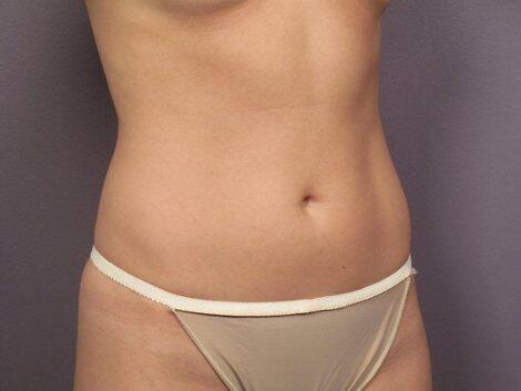 Liposuction Before & After Image