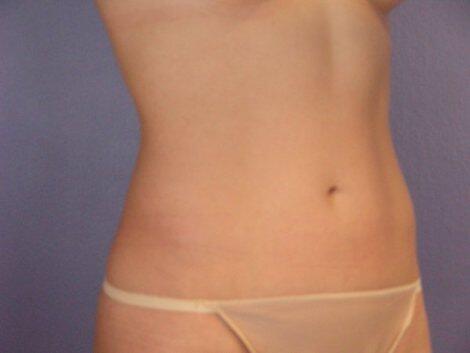 Liposuction Before & After Image