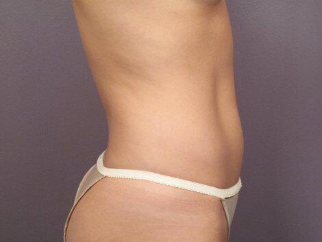 Liposuction Before & After Image