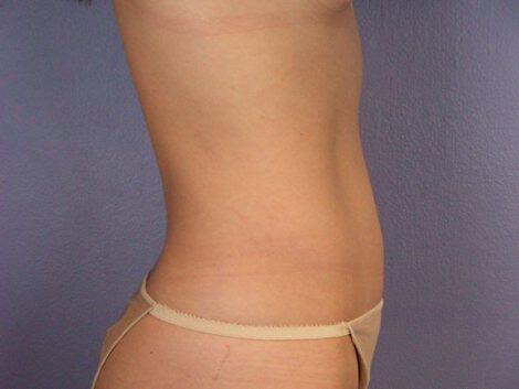 Liposuction Before & After Image