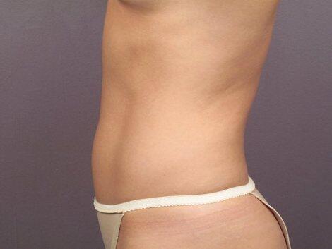 Liposuction Before & After Image