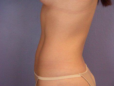 Liposuction Before & After Image