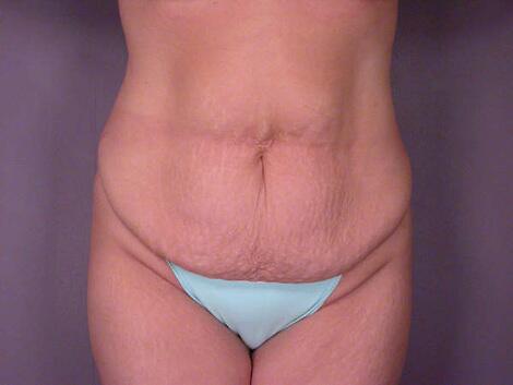 Liposuction Before & After Image