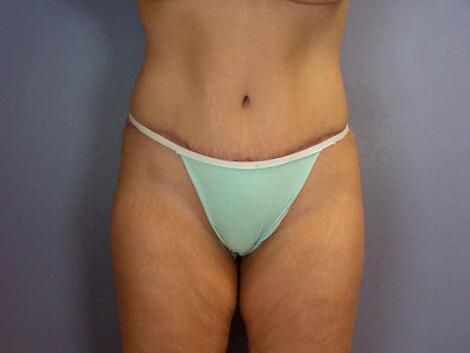 Liposuction Before & After Image