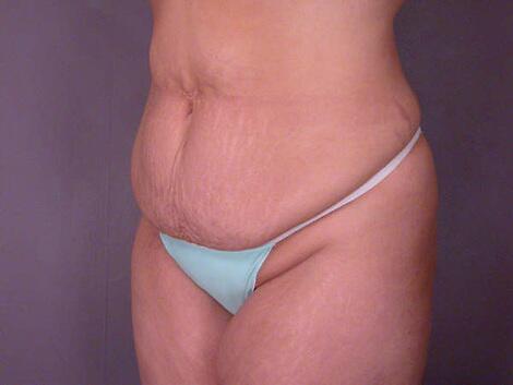 Liposuction Before & After Image