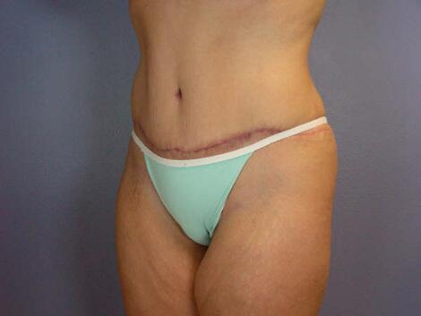 Liposuction Before & After Image