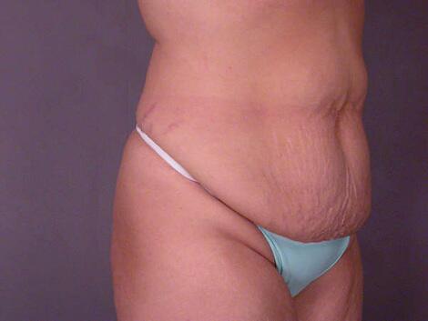 Liposuction Before & After Image