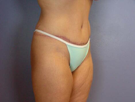 Liposuction Before & After Image