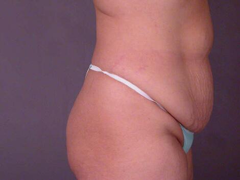 Liposuction Before & After Image