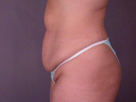 Liposuction Before & After Image