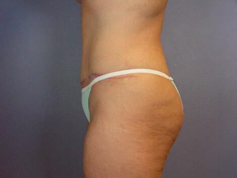 Liposuction Before & After Image