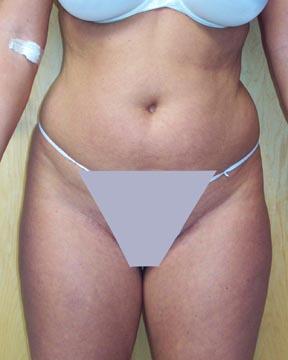 Liposuction Before & After Image