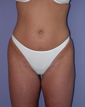 Liposuction Before & After Image