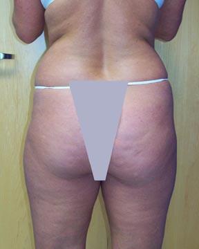 Liposuction Before & After Image