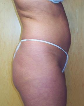 Liposuction Before & After Image