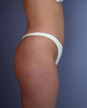 Liposuction Before & After Image