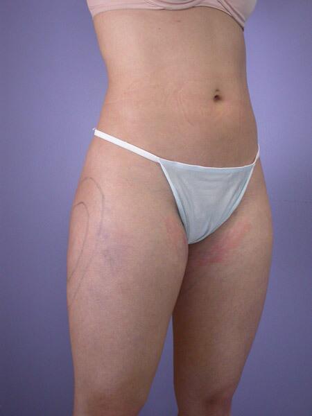 Liposuction Before & After Image