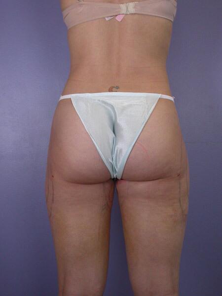 Liposuction Before & After Image