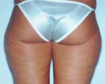 Liposuction Before & After Image