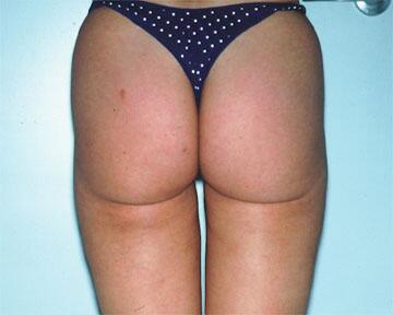 Liposuction Before & After Image