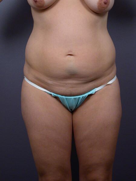 Liposuction Before & After Image