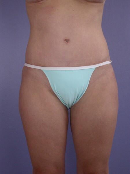 Liposuction Before & After Image